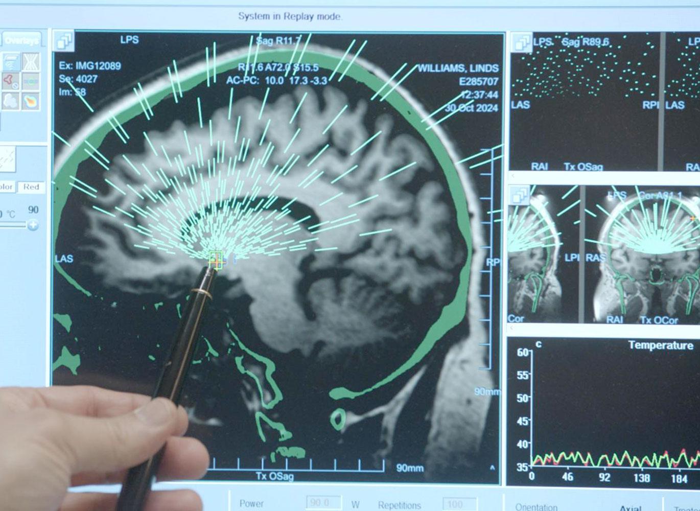 Dr. Ali Rezai describes the focused ultrasound procedure used to treat patient Lindsey Williams for binge-eating disorder.